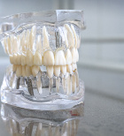 התקנת תותבות לאחר עקירה - תמונת המחשה